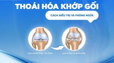 THOÁI HÓA KHỚP GỐI, ĐAU NHỨC KÉO DÀI: CHÂM CỨU CÓ GIÚP CẢI THIỆN TÌNH TRẠNG BỆNH?